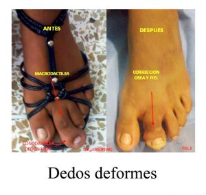 tratamiento-de-dedos-deformes-centro-integral-del-pie